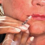 botox Botox Injections