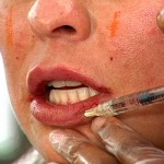 culipsinject Restylane in Lips