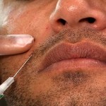 majidcuinject1 Restylane Injections