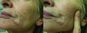 Chronic granuloma formation due to permanent dermal filler injection